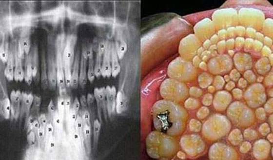 پسر عجیب هندی با 264 عدد دندان! (عکس)
