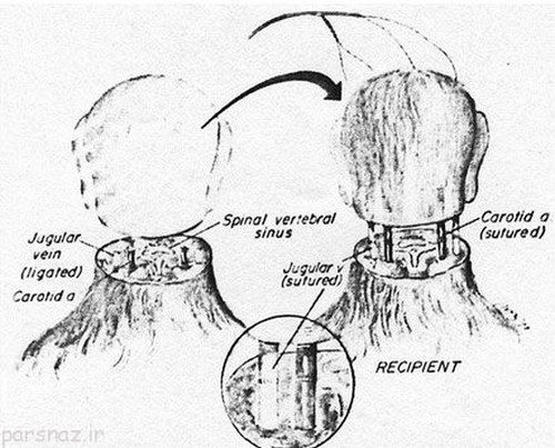 نتیجه اولین پیوند سر انسان چه خواهد شد (عکس)